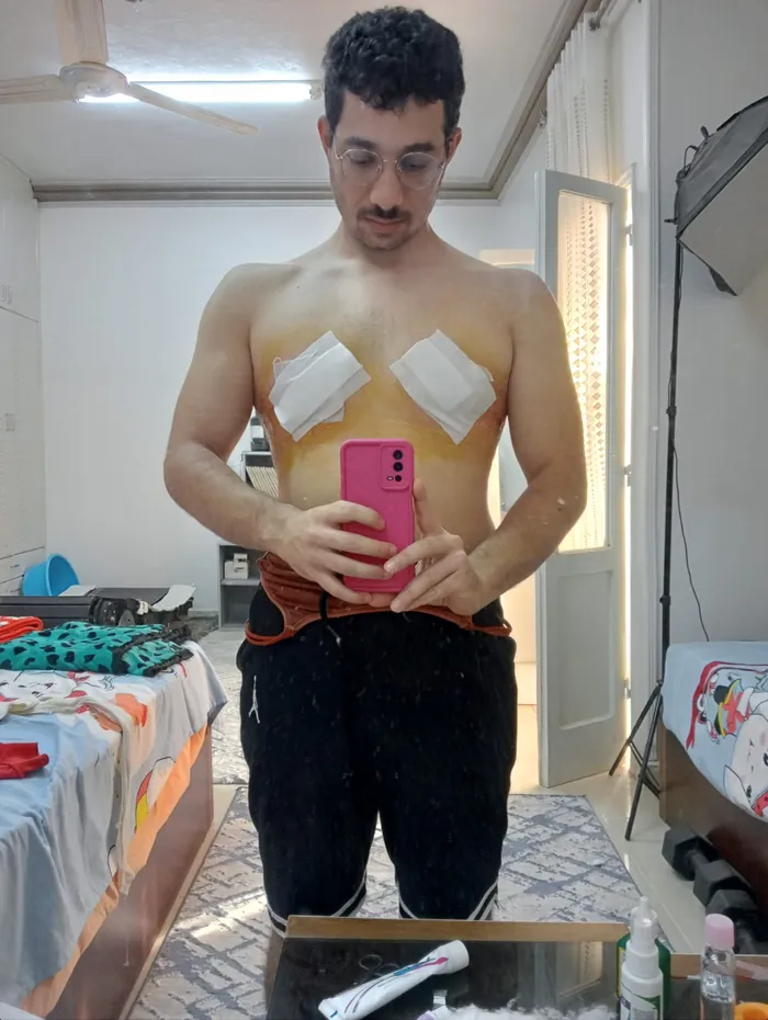 Moe in recovery, with dressings on his chest
